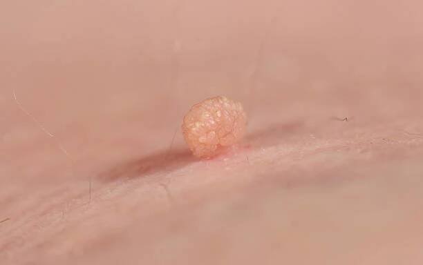 stopová kožní značka nebo akrochodon nebo měkký fibrom. papilloma bump na mužské tělo makro výstřel. fibroepithelial polyp na stonku. benigní léze epidermis zblízka. - papilom - stock snímky, obrázky a fotky