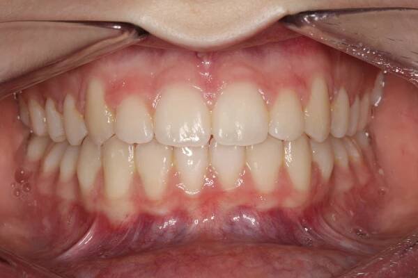 Bite Problems | Contour Orthodontists