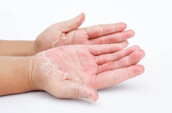 Understanding & Treating Fungal Infections Naturally at Bellaire ER