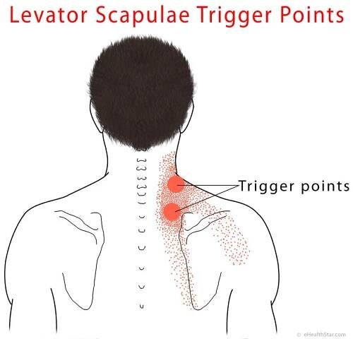 Levator scapulae trigger points
