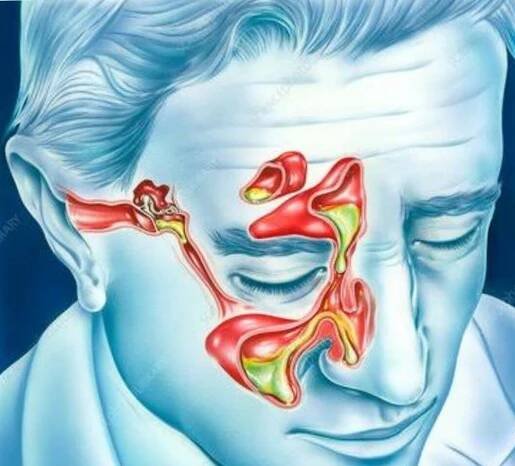 Hearing loss from Sinus Infection