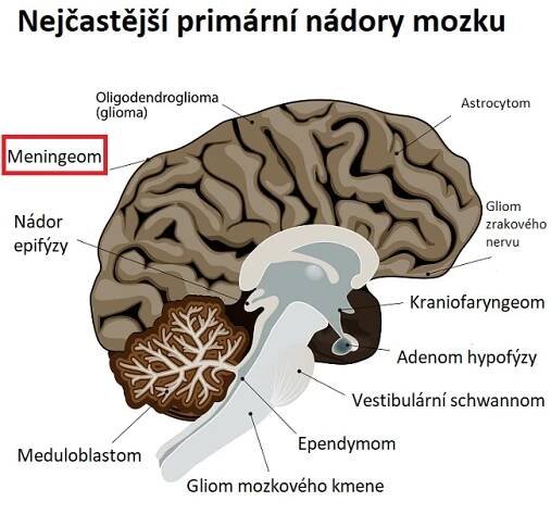 Meningeom na mozku - ilustrace