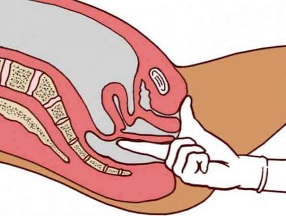 Interní hemoroidy příznaky a léčba / Proktologie | Užitečné informace a tipy na péči o sebe. Zdraví, výživa a další.