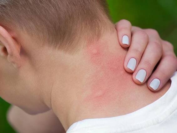 Do *Not* Crush A Tick If You Caught It Biting You (Even If You Want To)
