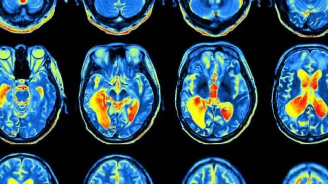 Diagnóza ADHD u dospělých zvyšuje riziko demence, zjistili vědci