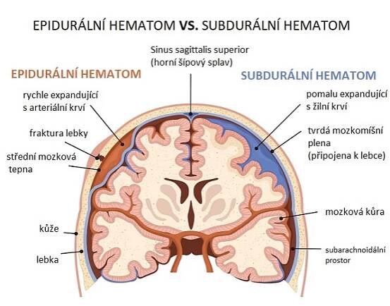 Epidurální hematom – co je to – příznaky, příčiny a léčba