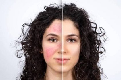 Koláž porovnávající zblízka před a po úspěšné léčbě růžovky na obličeji. Krásná kavkazská mladá dáma portrét na bílém pozadí. Medicína a koncept zdravotní péče. — Stock obrázek