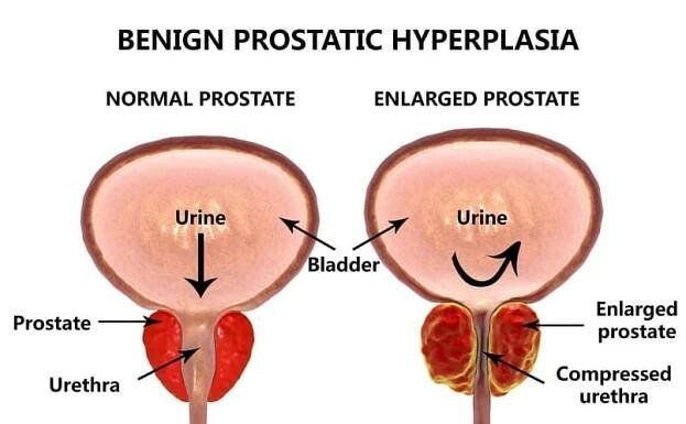 Prostatitída - Superionherbs.SK