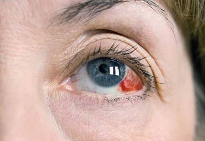 Nebezpečné účinky poškození očí - hemophthalmus / Články