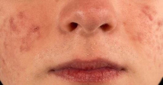 Příčiny akné podle místa jeho výskytu na obličeji
