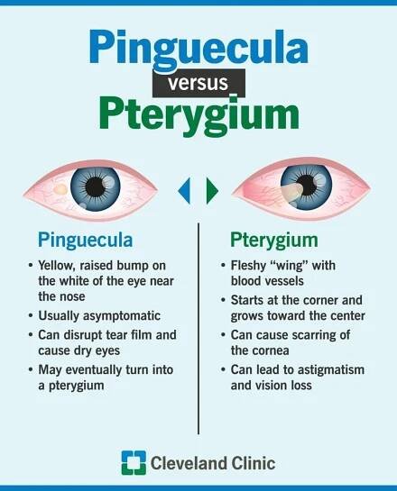 Infographic that describes the differences of a pinguecula and pterygium, and what they look like on the eye surface
