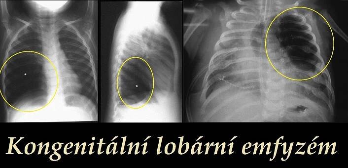 Kongenitální lobární emfyzém - příznaky, projevy, symptomy