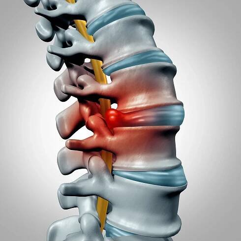Herniated Disk Concept — Stock obrázek