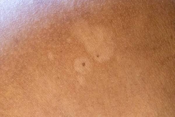 detail tinea versicolor nebo pityriasis versicolor na kůži ramene asijské ženy. pityriasis versicolor způsobuje změnu barvy skvrn na kůži. koncept dermatologie kožních problémů. - pityriasis - stock snímky, obrázky a fotky