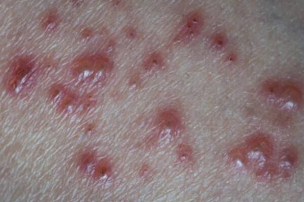 Kůže infikovaných Herpes zoster virus. — Stock obrázek