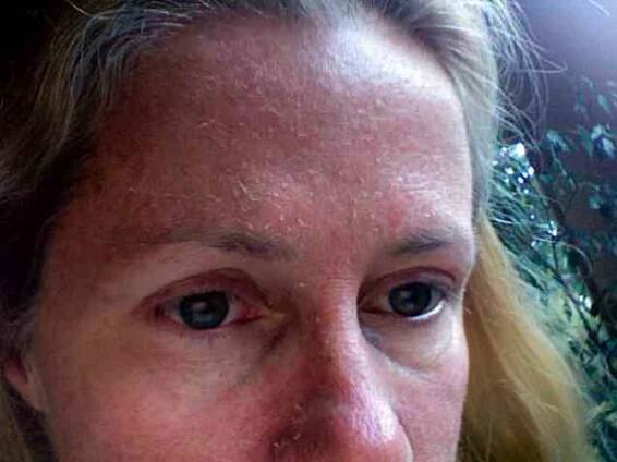 Léčba seboroické dermatitidy / Dermatologie | Užitečné informace a tipy na péči o sebe. Zdraví, výživa a další.