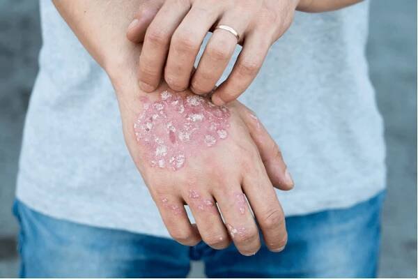 Lupénkou neboli psoriázou trpí v Česku kolem 300 tisíc pacientů