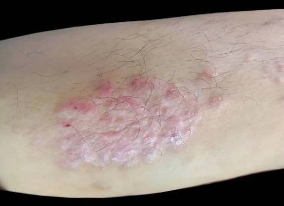 dermatofytóza, známá také jako tinea a pásový opar, plísňová infekce kůže - trichoficie - stock snímky, obrázky a fotky