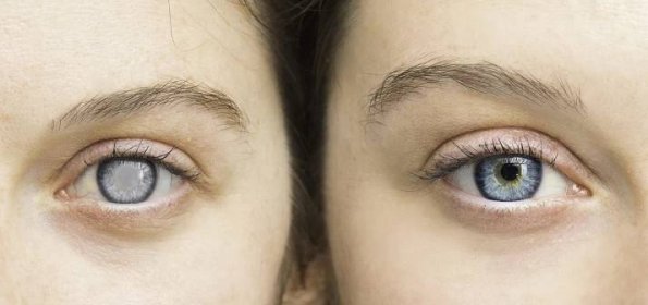 Glaukom: Příznaky, diagnostika a péče o oči