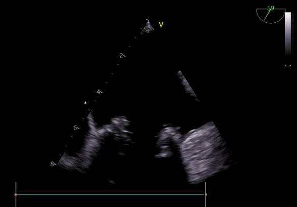 Infective endocarditis