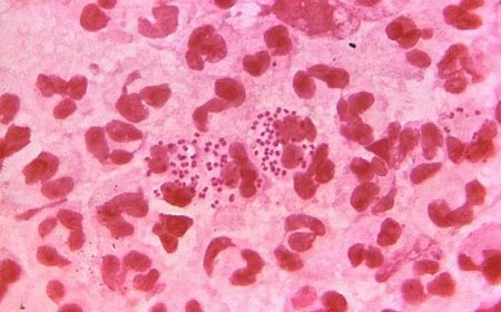 Spike in gonorrhoea cases post-pandemic prompts warning from health agency
