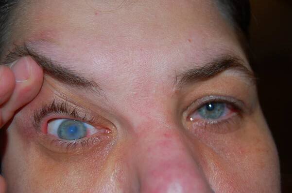 Corneal hydrops