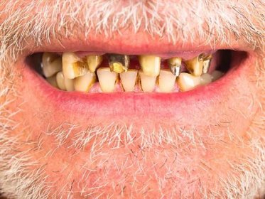 špatné zuby - kurděje - stock snímky, obrázky a fotky