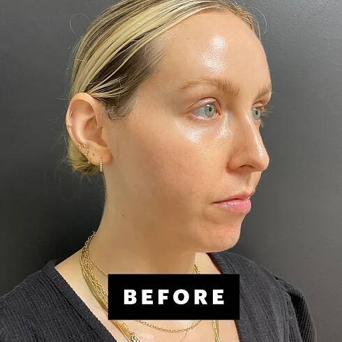 I Got Chin Filler for the First Time—See the Before-and-After Photos