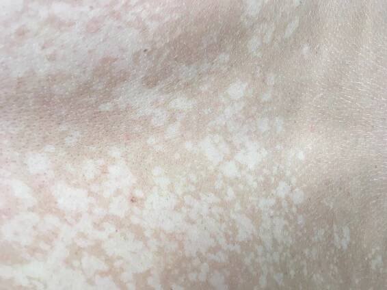Pityriasis versicolor | Dermaweb
