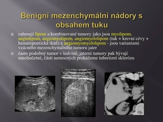 PPT - Benigní ložiskové léze jater PowerPoint Presentation, free download - ID:4010293