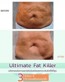 Ultimate fat killer - Mediglow Clinic