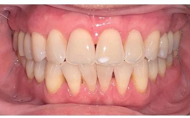 Before & After dental procedures - Dr Roxane Katiya, dentist in St-Bruno De Montarville
