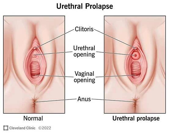 Urethral Prolapse: Causes, Symptoms, Diagnosis & Treatment