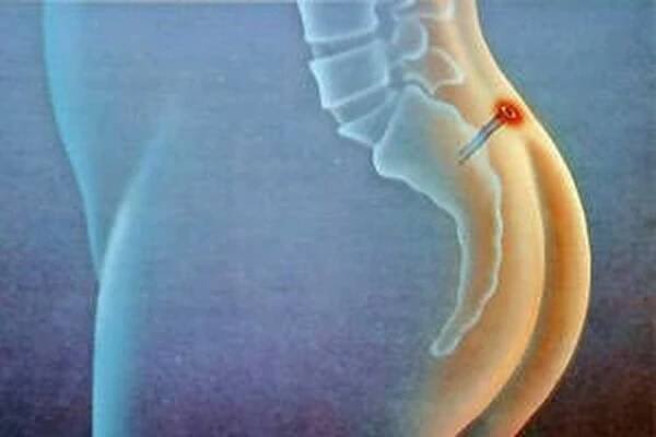 Symptomy cysty coccyxu, léčba a odstranění / Cyst
