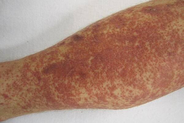 25 Facts About Systemic Necrotizing Angeitis 