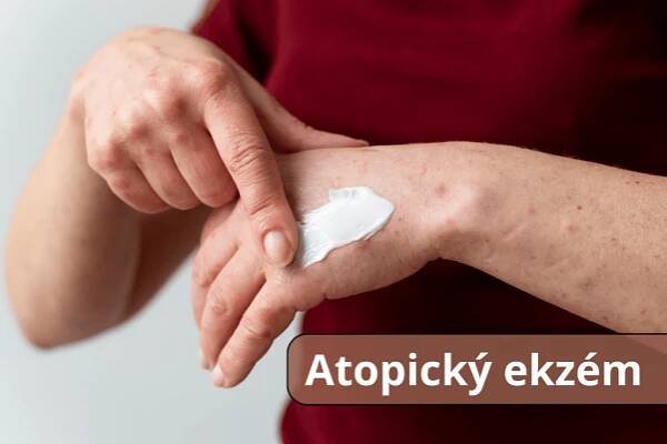 Atopický ekzém v kostce, co byste o něm měli vědět? - PanZdraví.cz