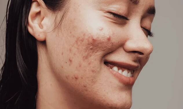 How to Reduce Pimple Redness at Home