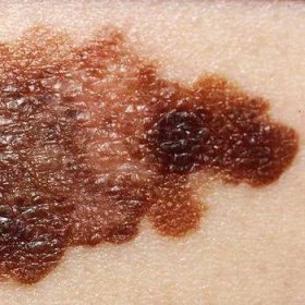 Jak rozpoznat melanom v rané fázi? Příznaky a příznaky kožního melanomu (foto) 