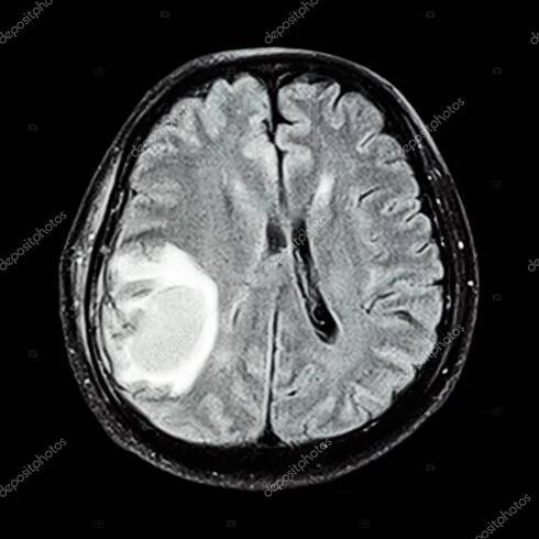 MRI mozku: show mozku nádor v pravém mozkovém laloku mozku