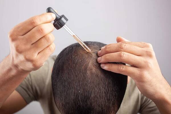 muž používající minoxidil na plešatou pokožku hlavy k léčbě vypadávání vlasů - seboroická dermatitida - stock snímky, obrázky a fotky