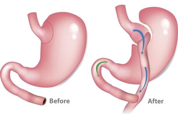 Bariatric Surgery - Coryell Health