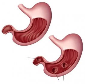 Vlevo zdravý žaludek, vpravo dole peptické vředy.