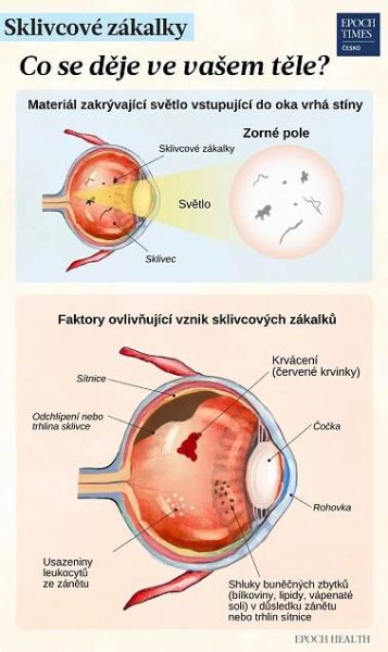 Sklivcové zákalky: Příznaky, příčiny, léčba a přirozené přístupy
