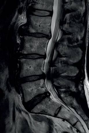 Obr. 4 Multietážová lumbální spinální stenóza s maximálním nálezem v etáži L4/5 s protruzí intervertebrálního disku a spondylartrózou zadních segmentů