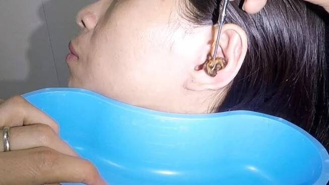 Massive Earwax Removed from Woman's Ear