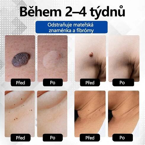 RICPIND® DermaLite Multifunkční laserové pero na odstranění bradavic a obnovu pleti🌿