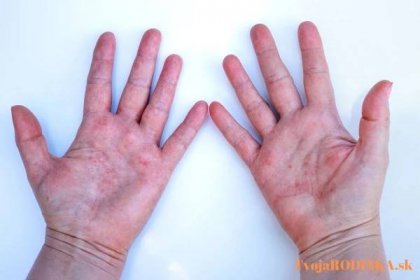 Atopic Dermatitida, Červené ruce, Dermatologický problém, Ženské ruce, Alergie a svědění, Minimální koncept, Bílé pozadí — Stock obrázek
