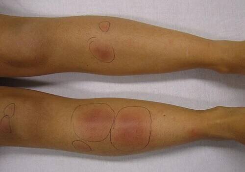 Erythema nodosum - Wikipedia