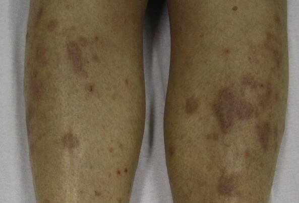Lichen Planus