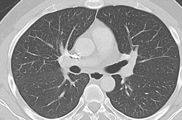 Aufnahme eines Thorax-CT